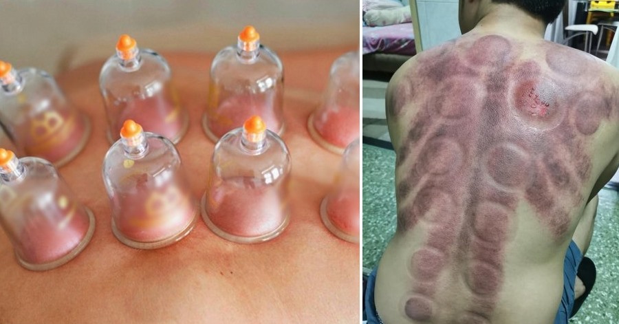 ofw chef suffers massage cupping in singapore